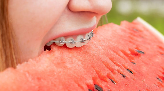 The 2026 Braces Diet guide: What to Eat in Your First Week for Faster, Painless Healing