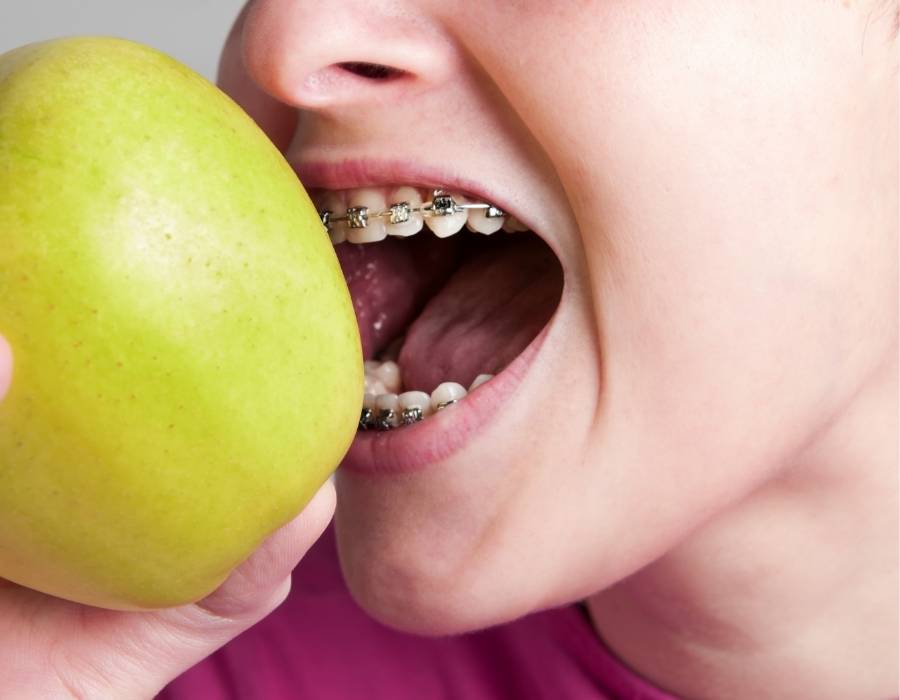 Braces Diet