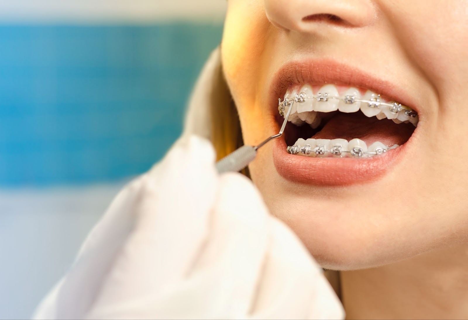 Managing Braces