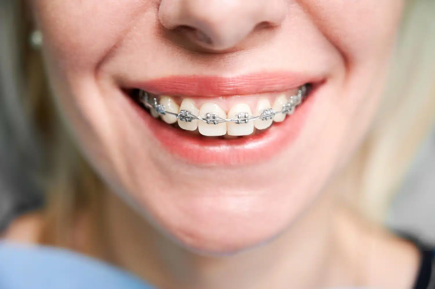 Braces Diet