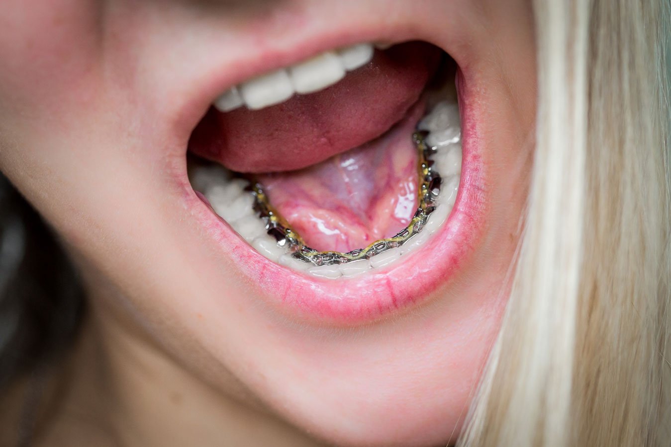 First Week with Braces: A Soft Food Guide for Less Pain