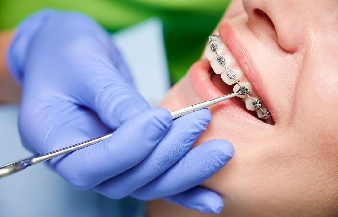Braces Diet