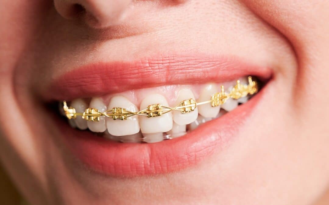 Braces Diet