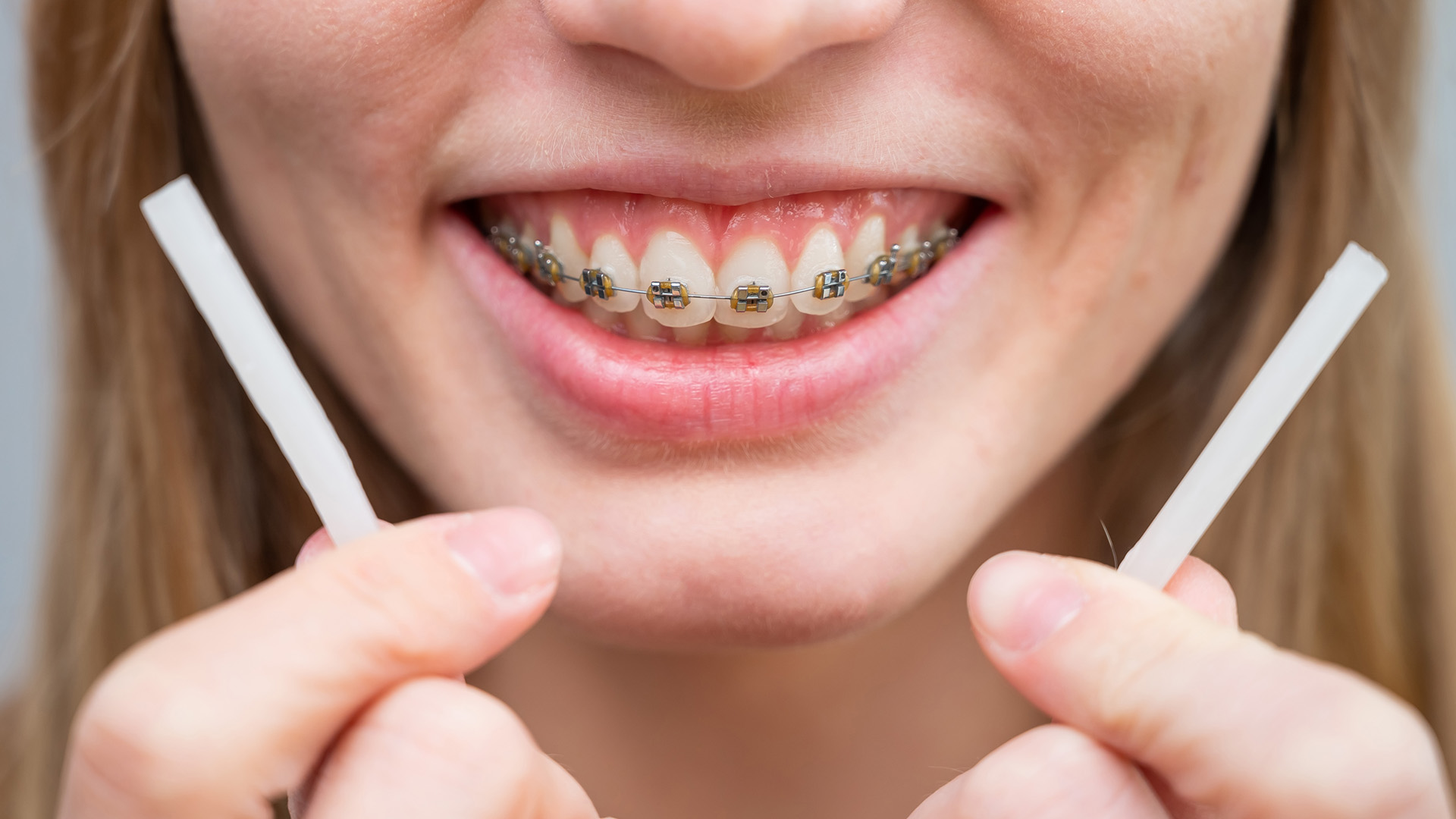 Braces Diet