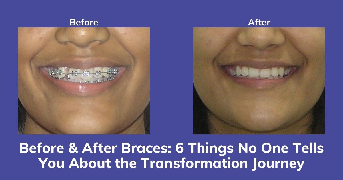 The 2026 Braces Journey: Managing Braces with Smart Diet Tips & Easy Flossing Hacks