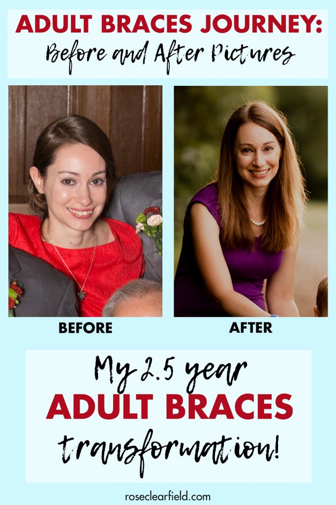 The Braces Journey