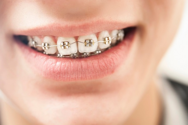 Braces