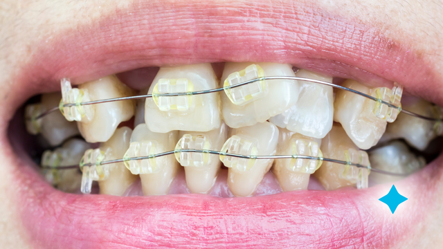 Braces