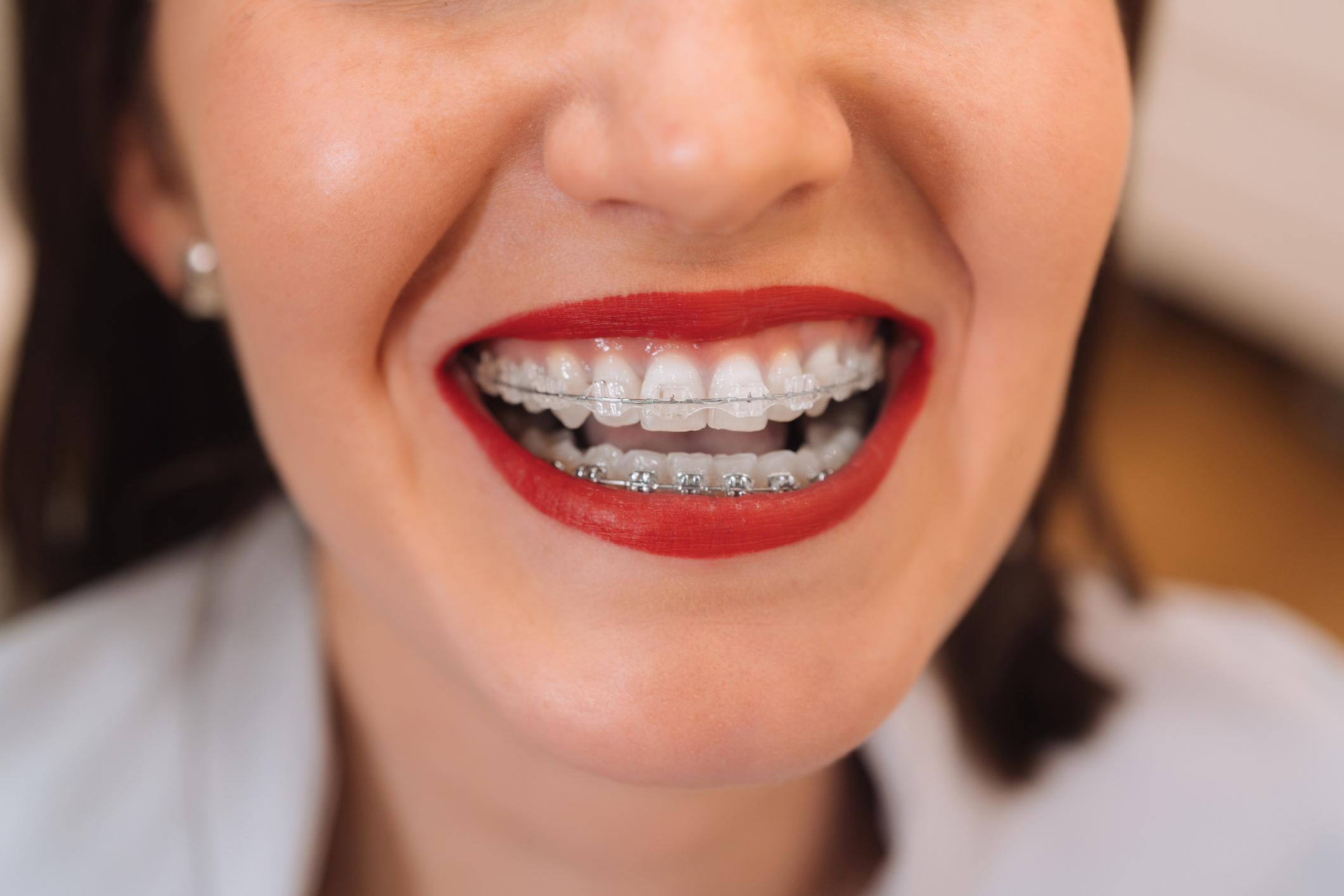 The 2026 Braces guide: Mastering Your First Week and Essential Orthodontic Care