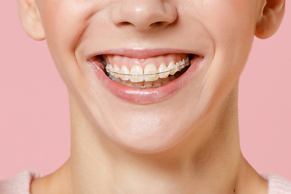Braces