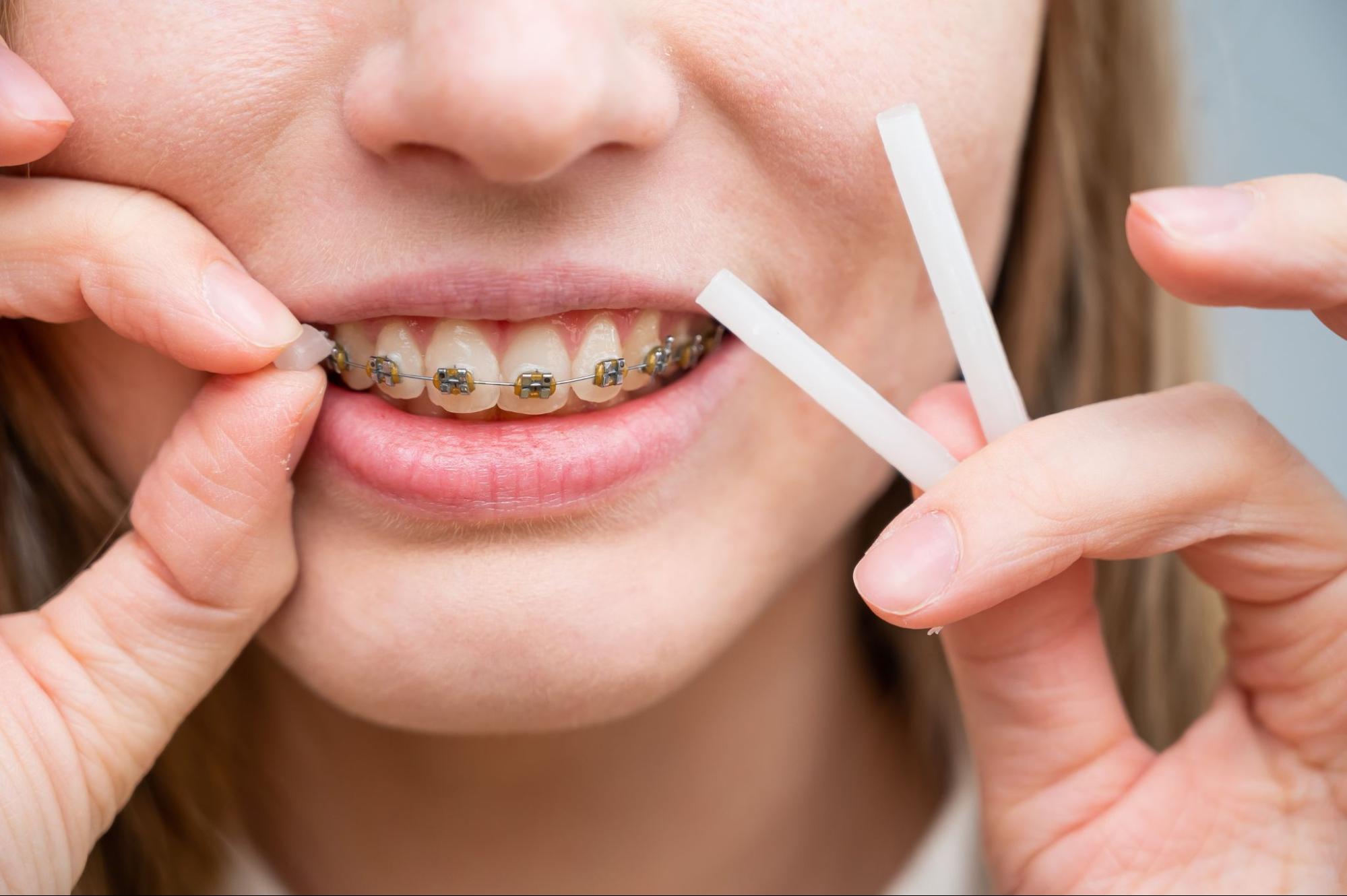 Managing Braces