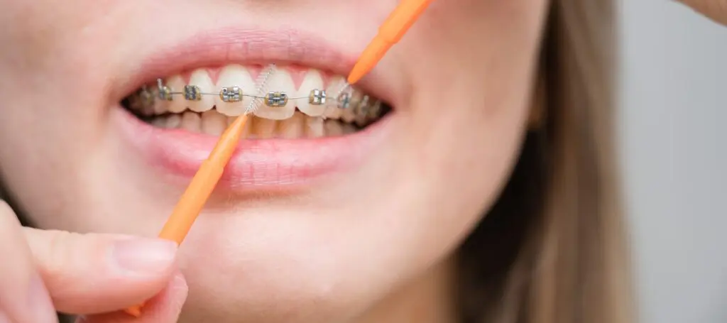 Managing Braces