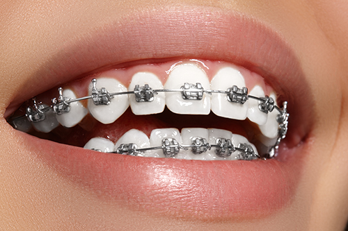 First Week with Braces
