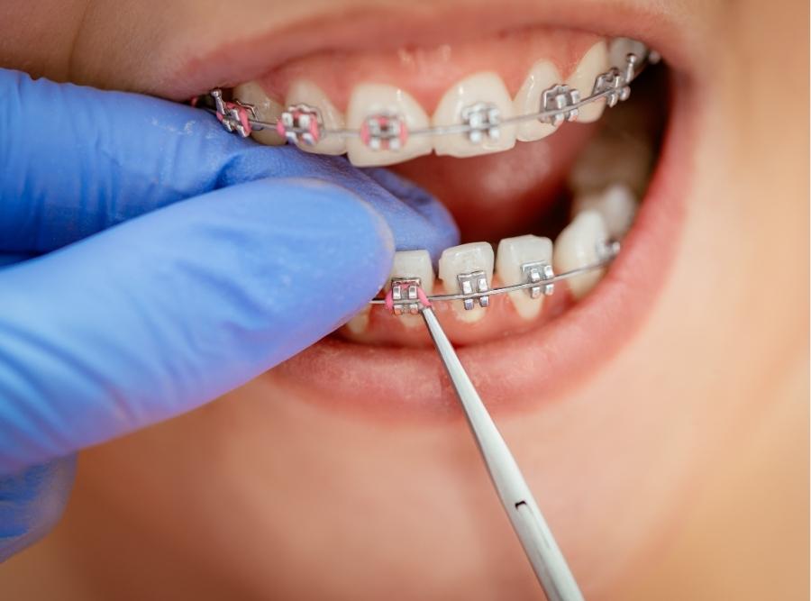 First Week with Braces