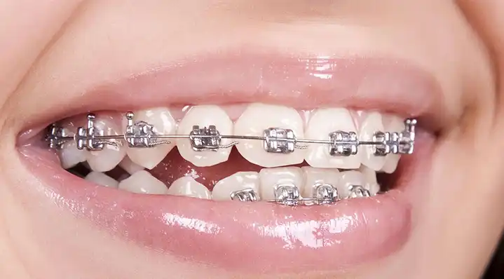 Smart Braces Technology 2026: How AI-Powered Orthodontics Are Revolutionizing Your Braces Journey