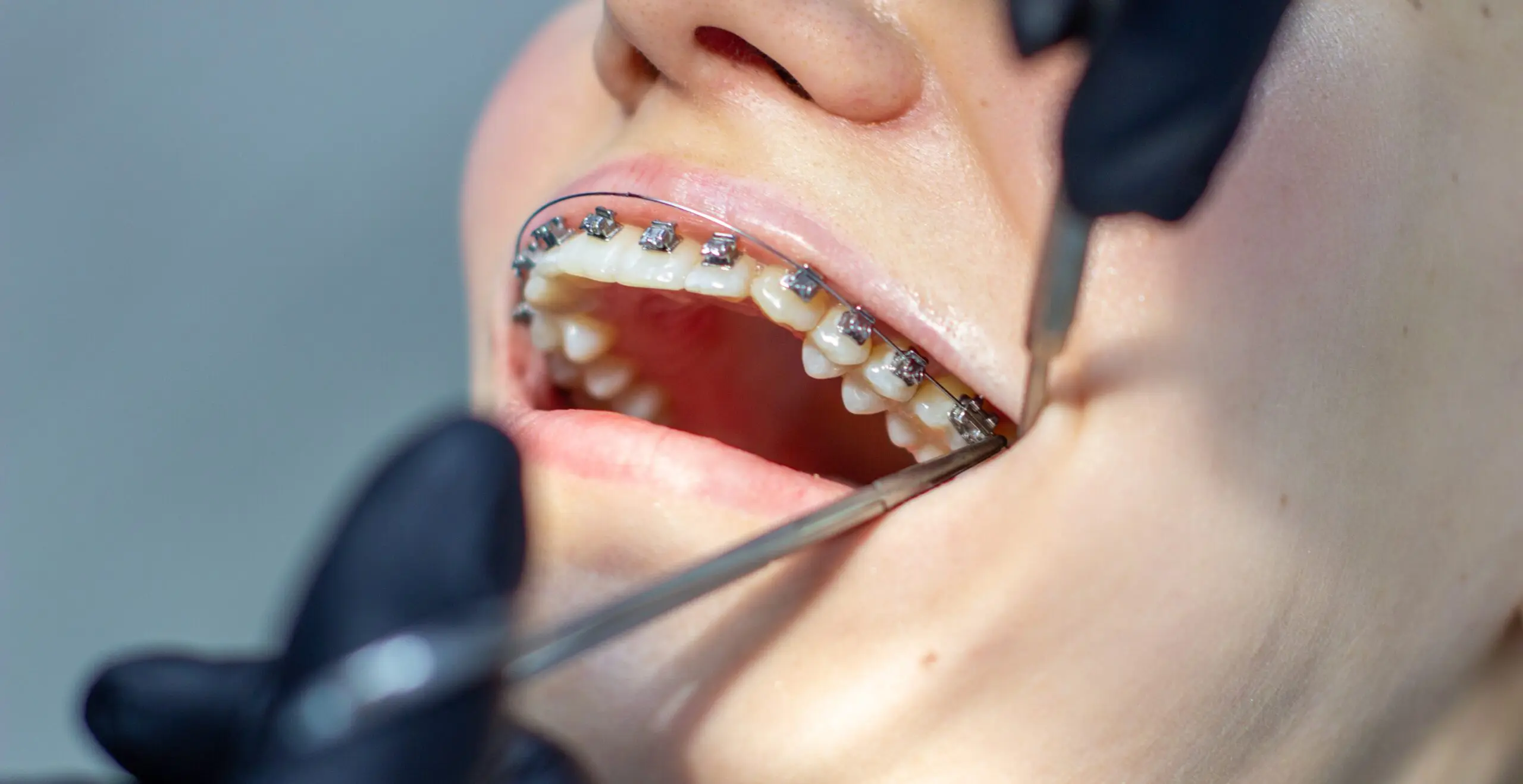 Managing Braces
