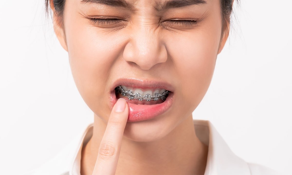 Managing Braces