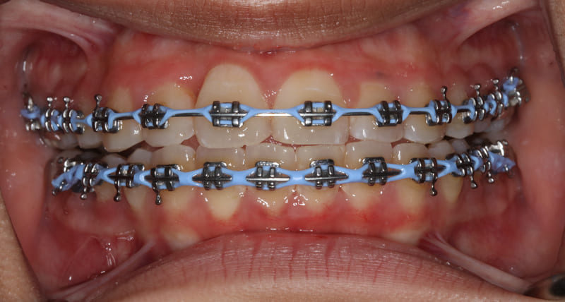 The 2026 Orthodontic Revolution: How to Master Your Braces Journey with AI-Enhanced Care and Modern Diet Tips