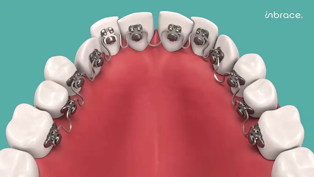 Braces Journey