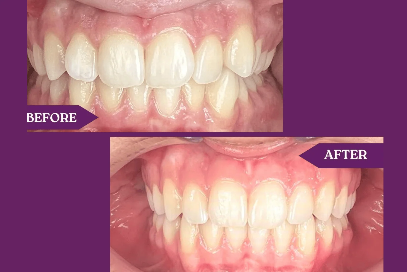 Your Braces Journey: A Step-by-Step Guide to Success