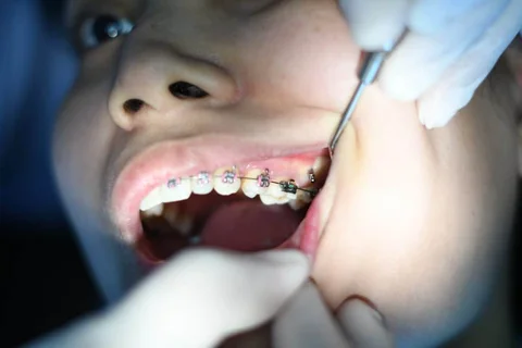 Braces Journey