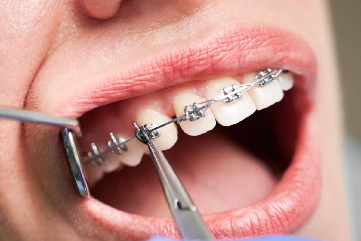 Your First Week with Braces: A Practical Guide