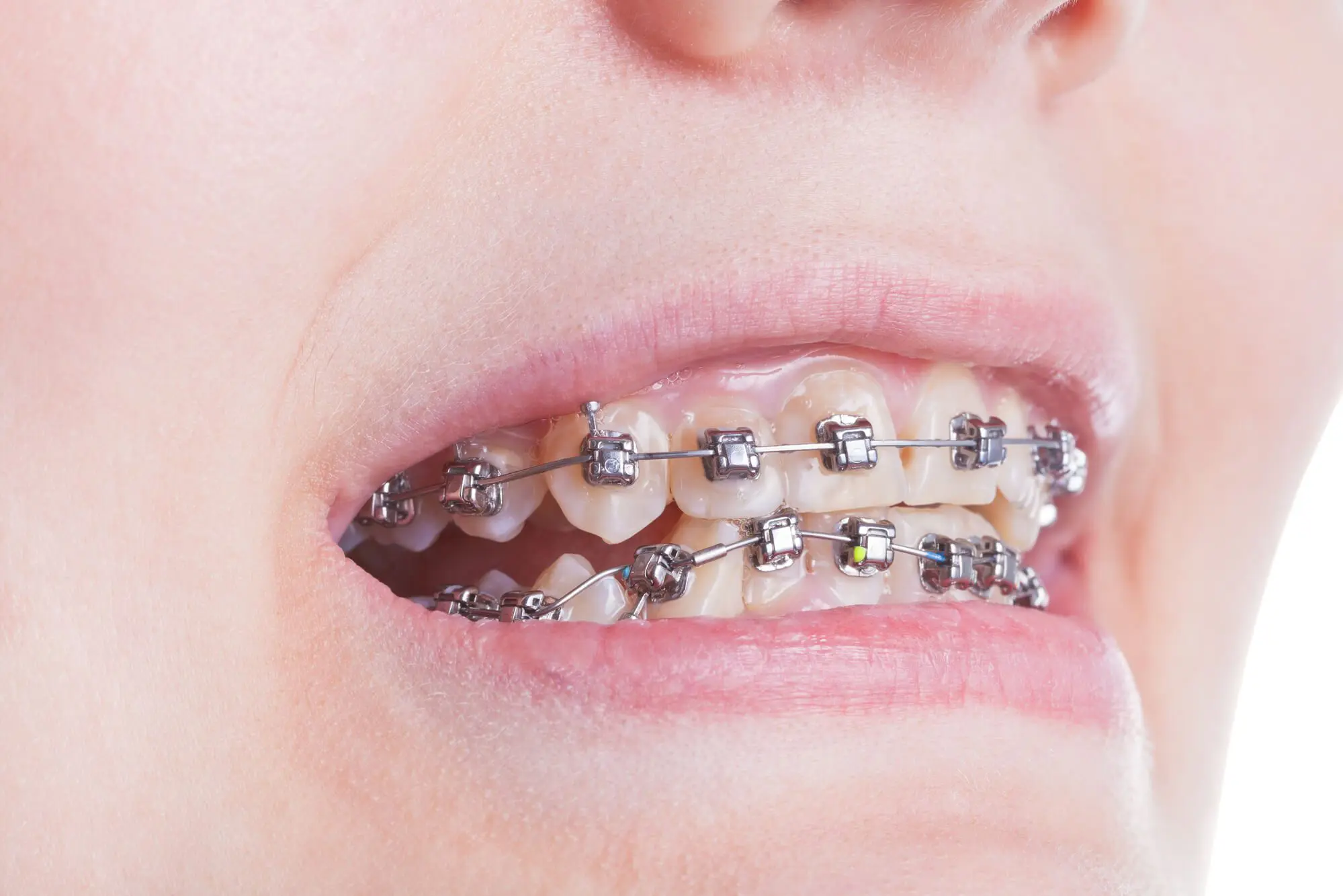 How Braces Work: A Step-by-Step Guide to Treatment