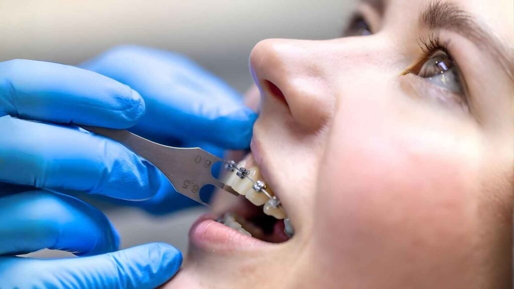 Your First Week With Braces: A Practical Braces Guide
