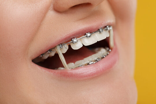 Braces