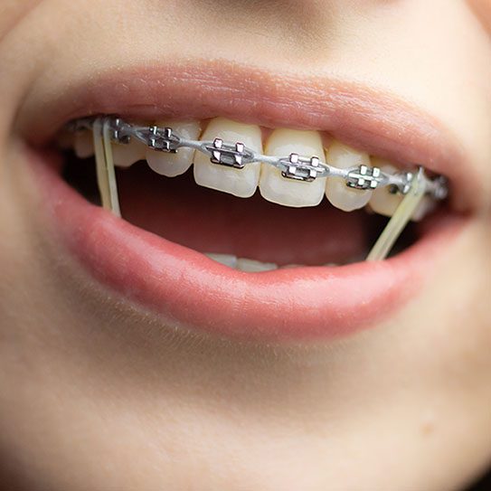Braces