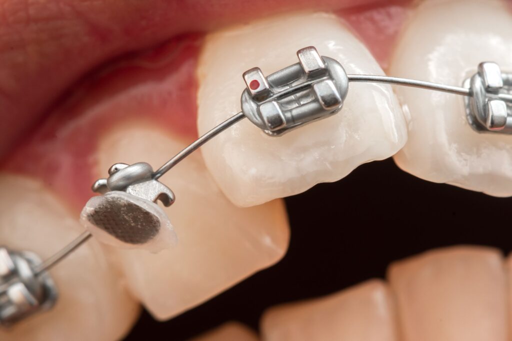 Braces