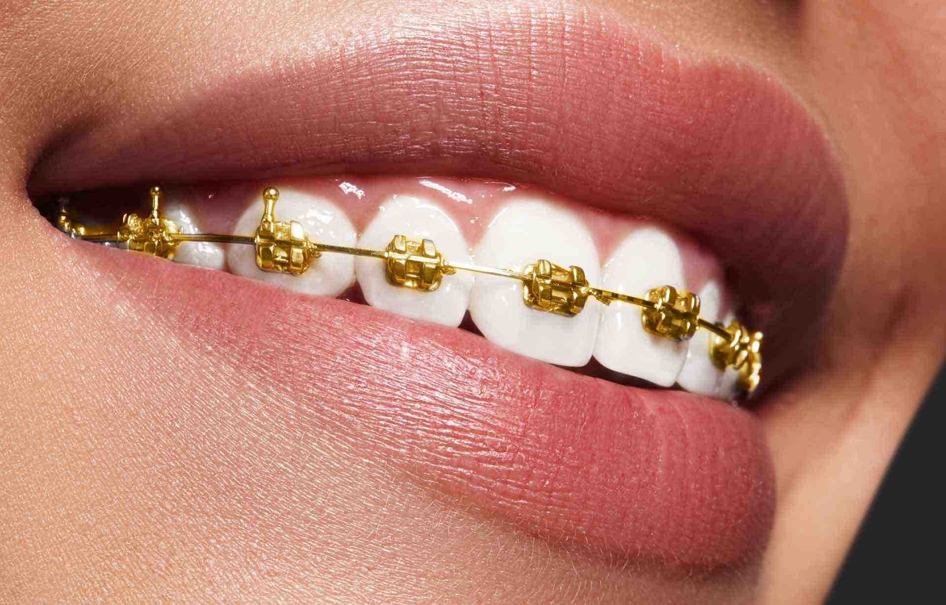 Braces Guide: First Week Care and Diet Tips