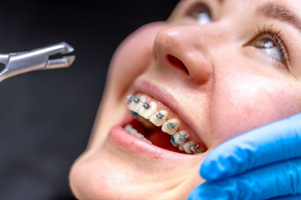 Braces Guide: First Week Survival and Care Steps