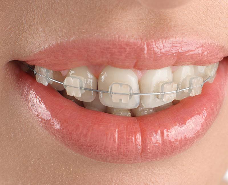 The Braces