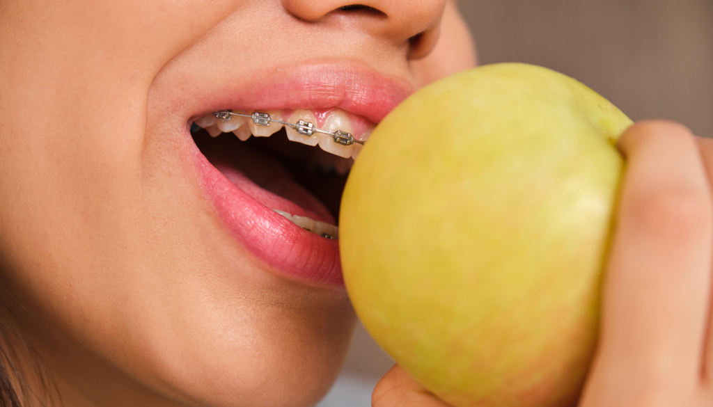 Braces Diet