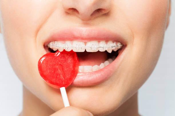 Braces Diet