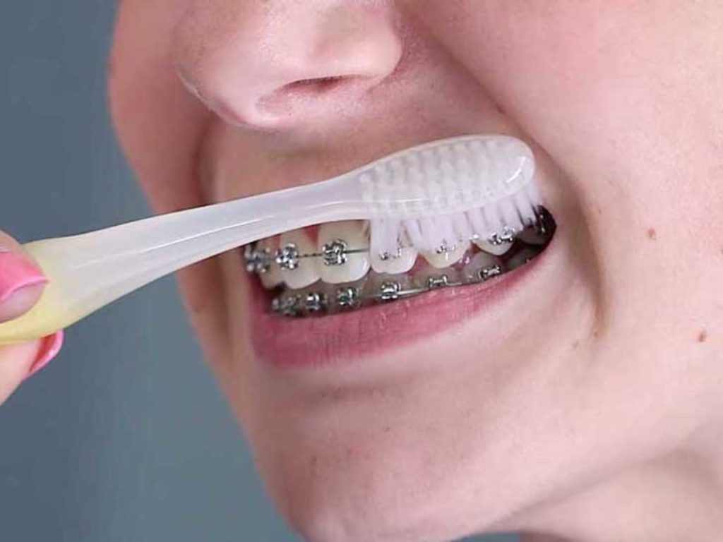 Braces Diet