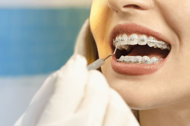 First Week with Braces