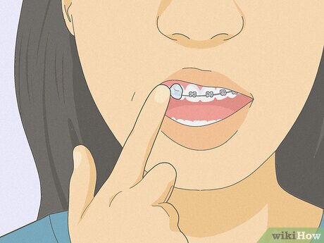 First Week with Braces: The Soft Food Survival Guide