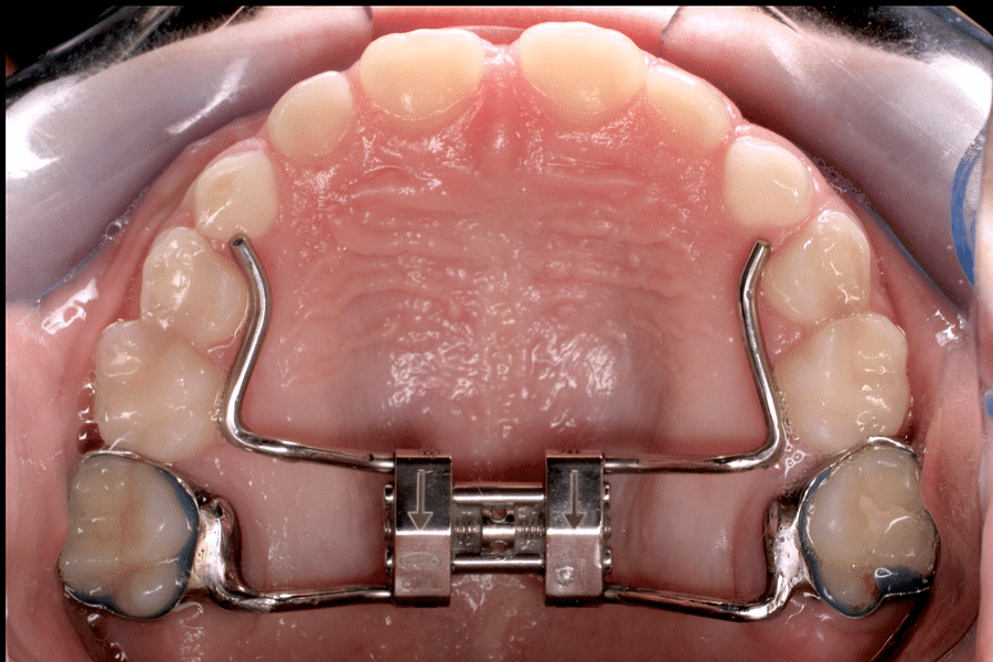 crowded teeth braces