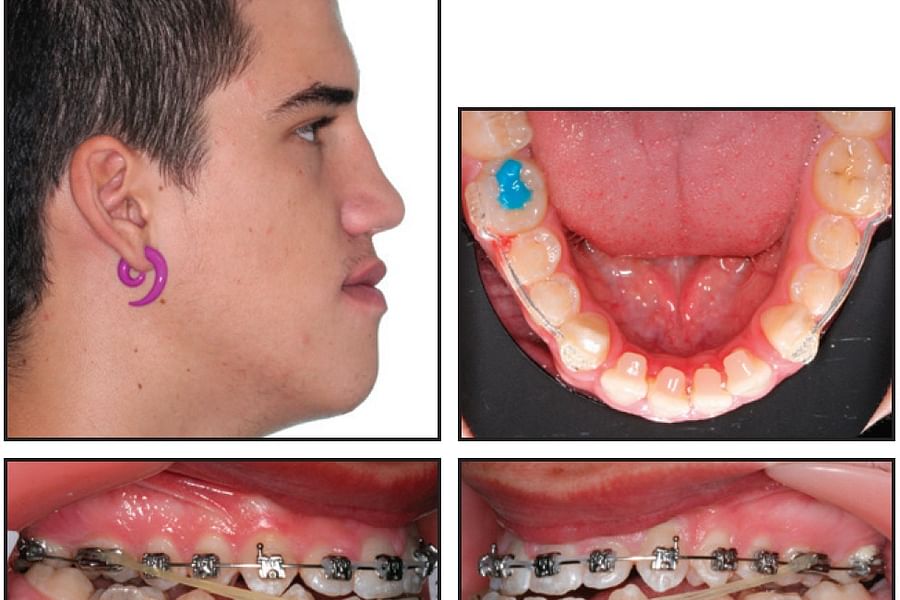 Malocclusion braces