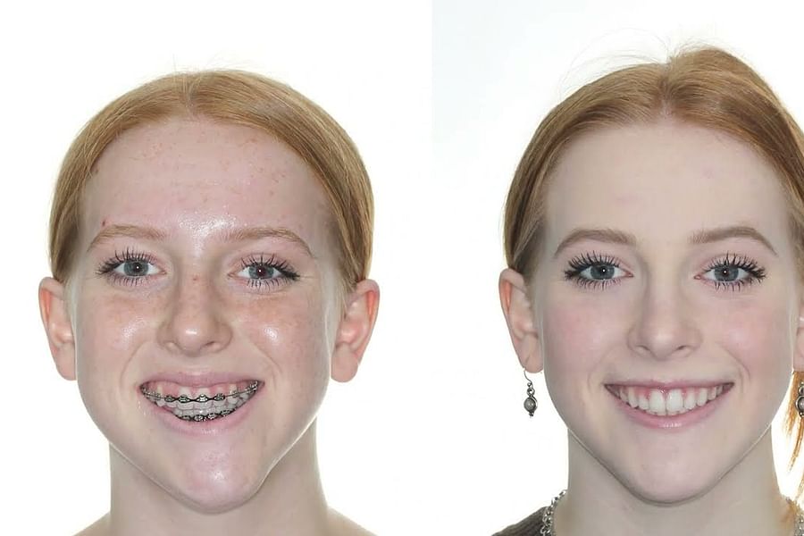 misaligned jaws braces