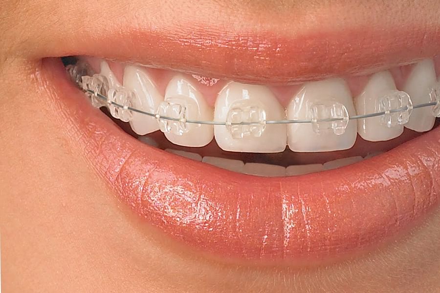 clear braces