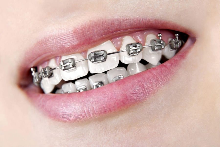 disclosing tablets for braces