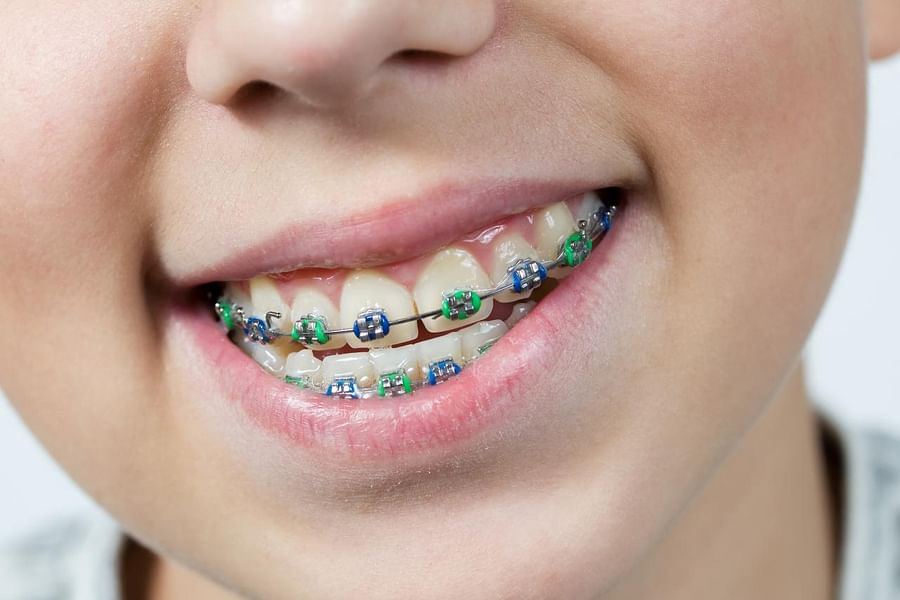rainbow colored braces