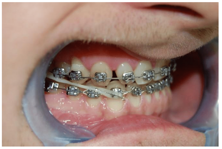 Brace Yourself A Comprehensive Guide on How Braces Move Teeth