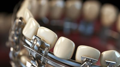 The Rubber Band Effect: How These Tiny Components Make a Big Difference in Aligning Your Smile