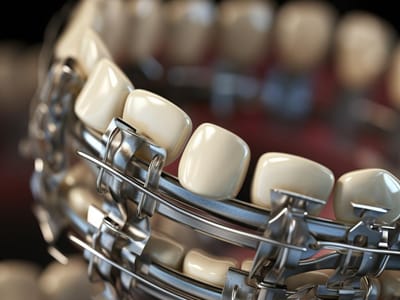 The Rubber Band Effect: How These Tiny Components Make a Big Difference in Aligning Your Smile