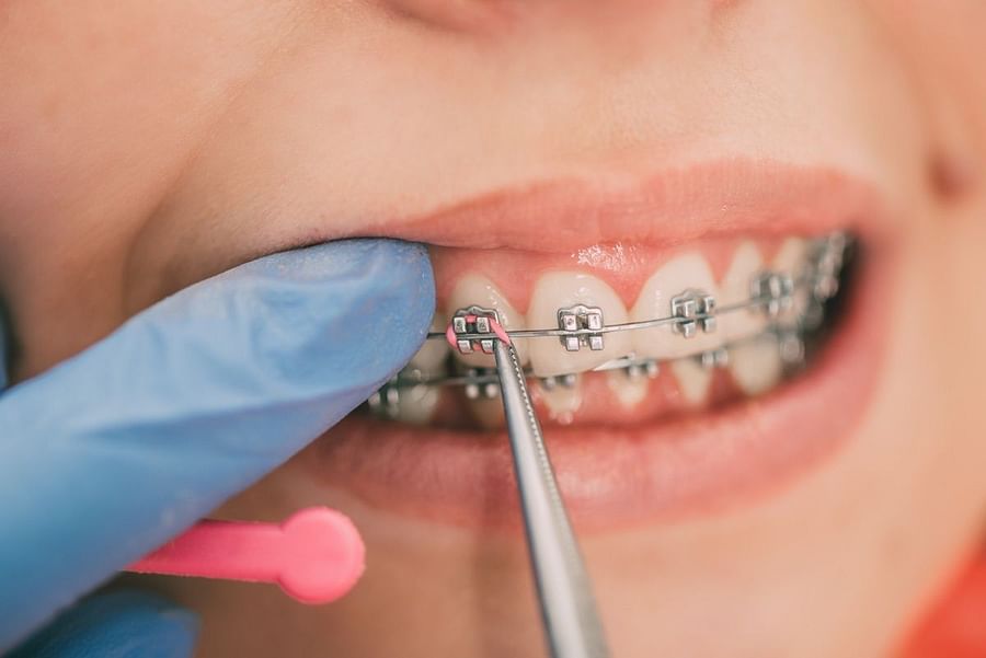 Understanding the Purpose of Rubber Bands in Braces and How They Work