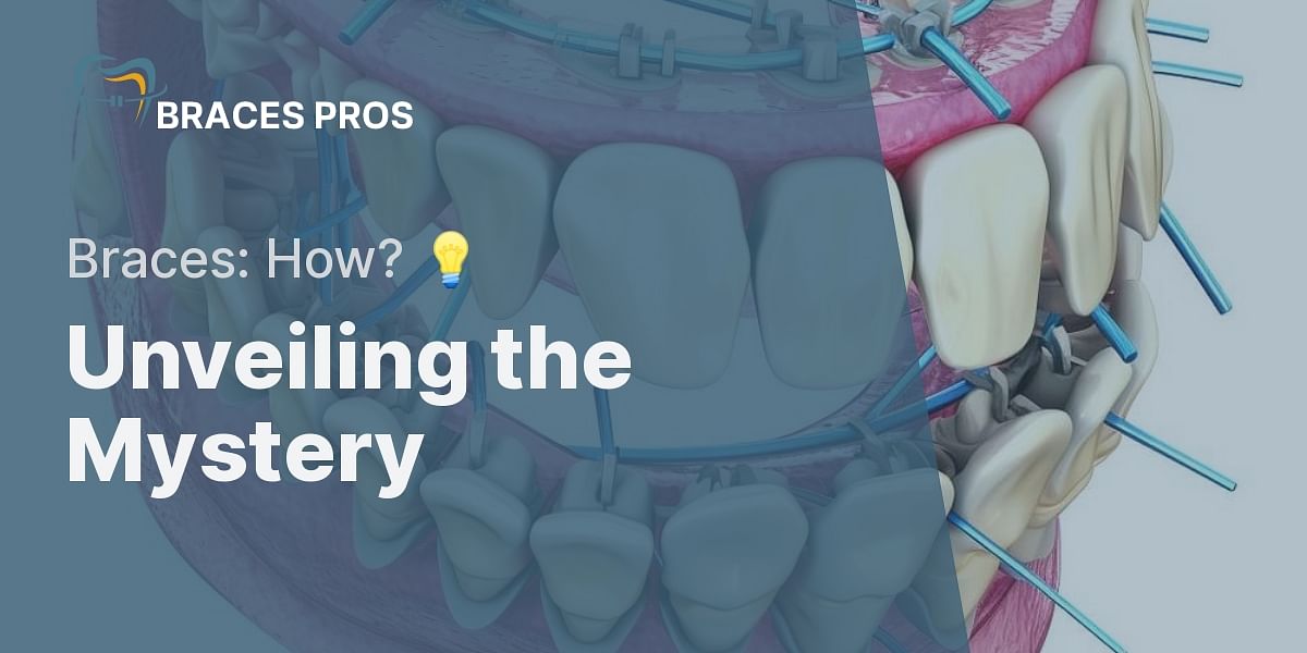 How do braces function?